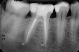 endodontické ošetření